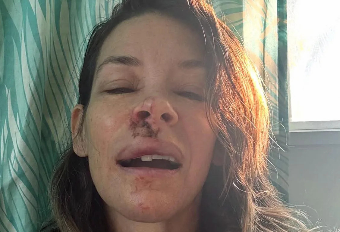 Evangeline ngất xỉu trên biển, rách mặt, chấn thương não