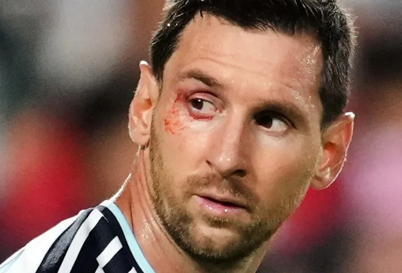 Messi bị rách mí mắt sau một pha tranh chấp bóng với Xhaka