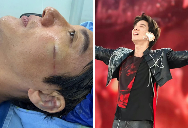 Vương Lực Hoành ngã xuống cầu thang khâu 39 mũi